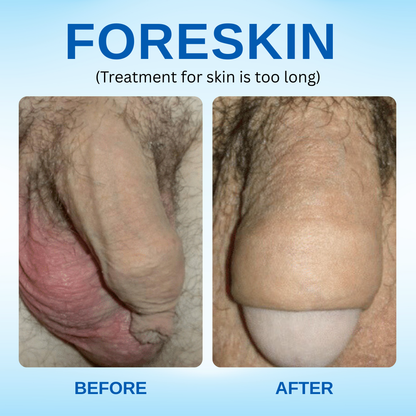 🏆RZXEA™ Redundant Prepuce Corrector Gel - ✨Advanced Hygiene & Aesthetic Care for Men 🛡️