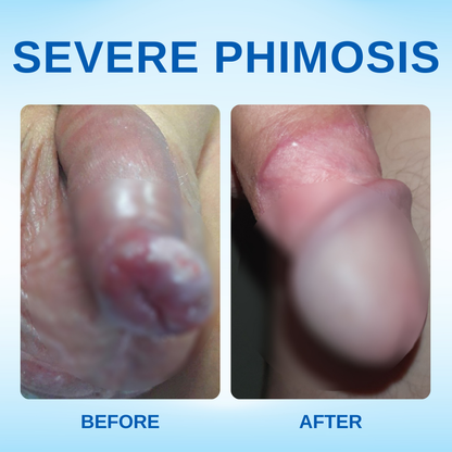 Rzxea™ Redundant Prepuce Corrector Gel